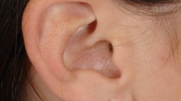 Ear lobe repair