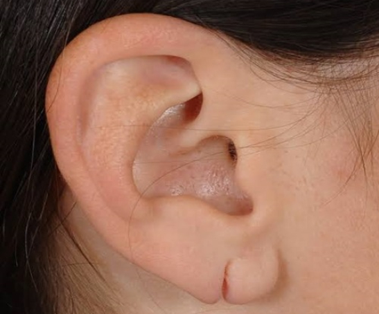 Ear lobe repair