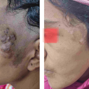 AV malformation face