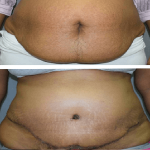 Abdominoplasty