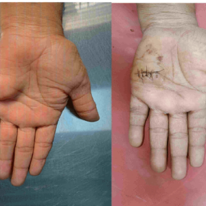 Biopsy Palmar fibromatosis rare case