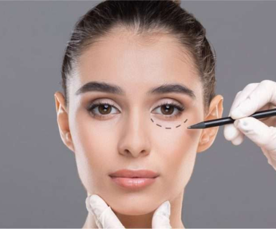 Blepharoplasty