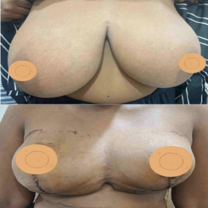 Breast Reduction