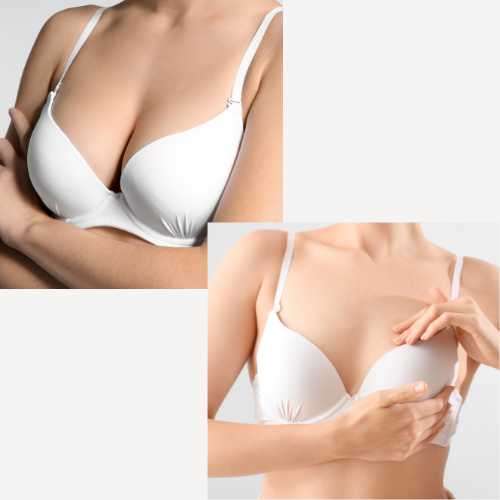 Breast reduction