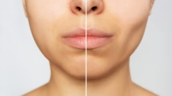 Buccal fat pad removal