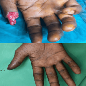 Cross finger flap for crush injury thumb