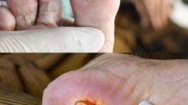 diabetic foot