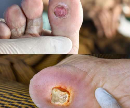 diabetic foot