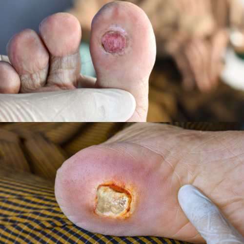 diabetic foot
