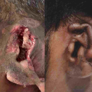 Ear reconstruction