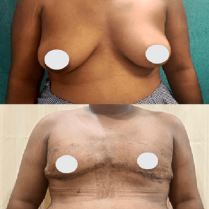FTM breast reduction