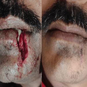 Fine Suturing Face