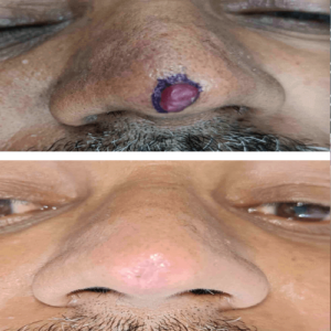 Granuloma Nose