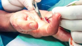 Hand surgery