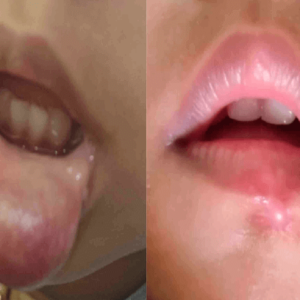 Hemangioma Lip