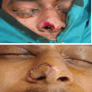 Nasal defect repair with forehead flap