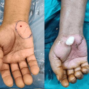 Nerve sheath tumor hand