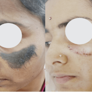 Nevus Face