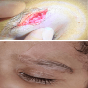 Scarless suturing