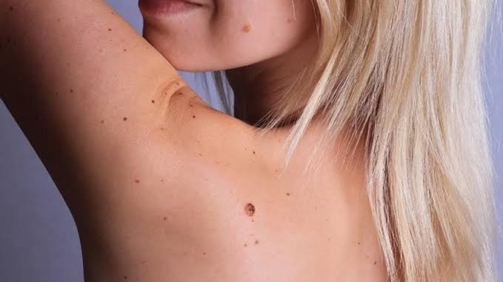 Skintags, Warts, Moles