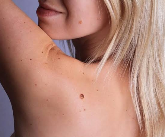 Skintags, Warts, Moles