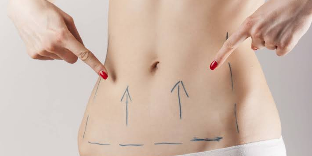 Tummy tuck
