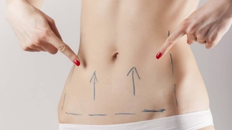 Tummy tuck