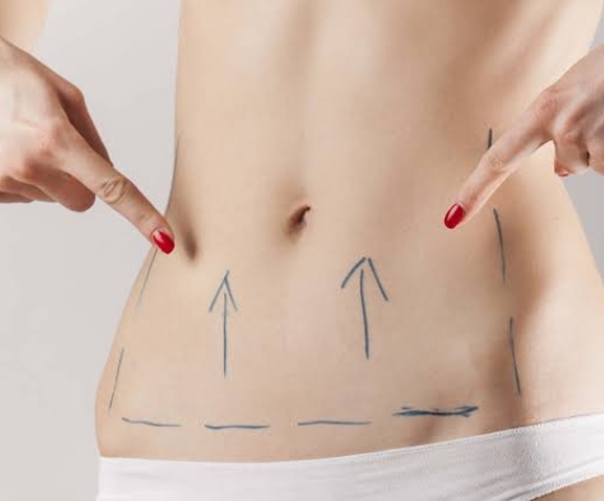 Tummy tuck