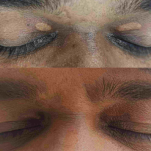 Xanthelasma excision